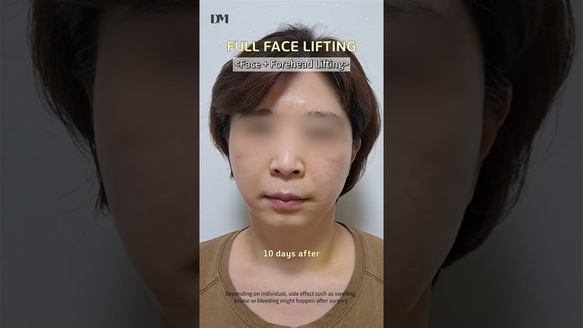 Recovery of face lift?  #viral #fyp #trending #facelift #necklift #foreheadlift #rejuvenation #lol