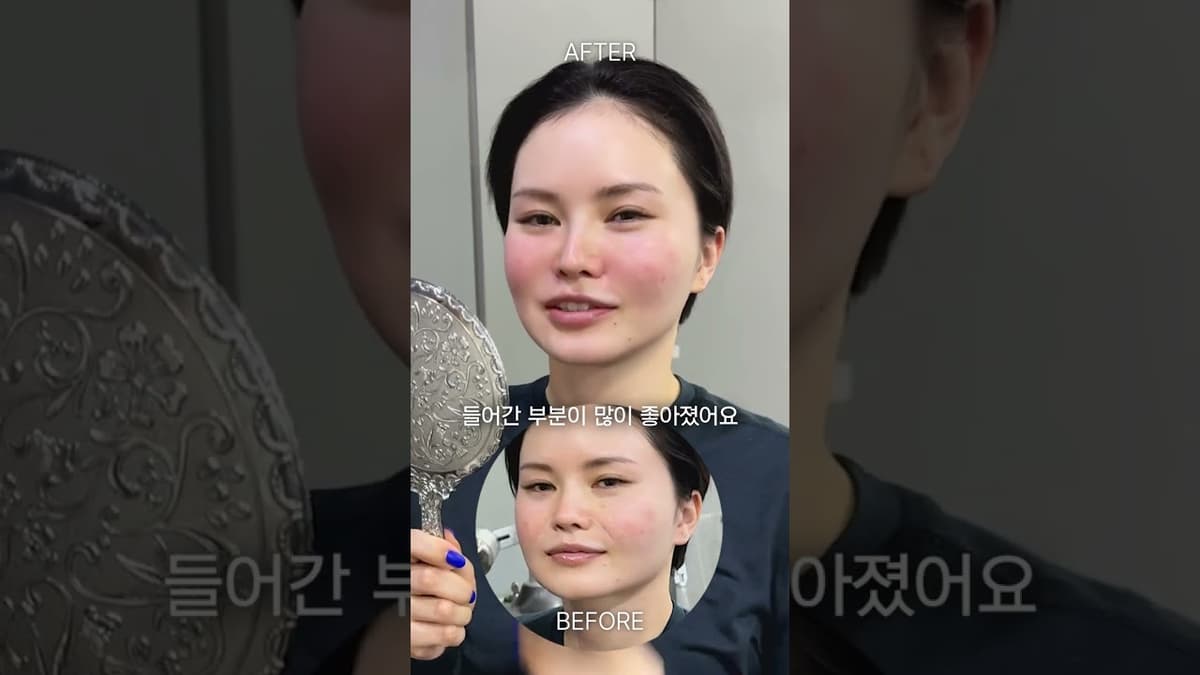 팔자주름 없애는 기적의 시술 쥬브젠 ✨