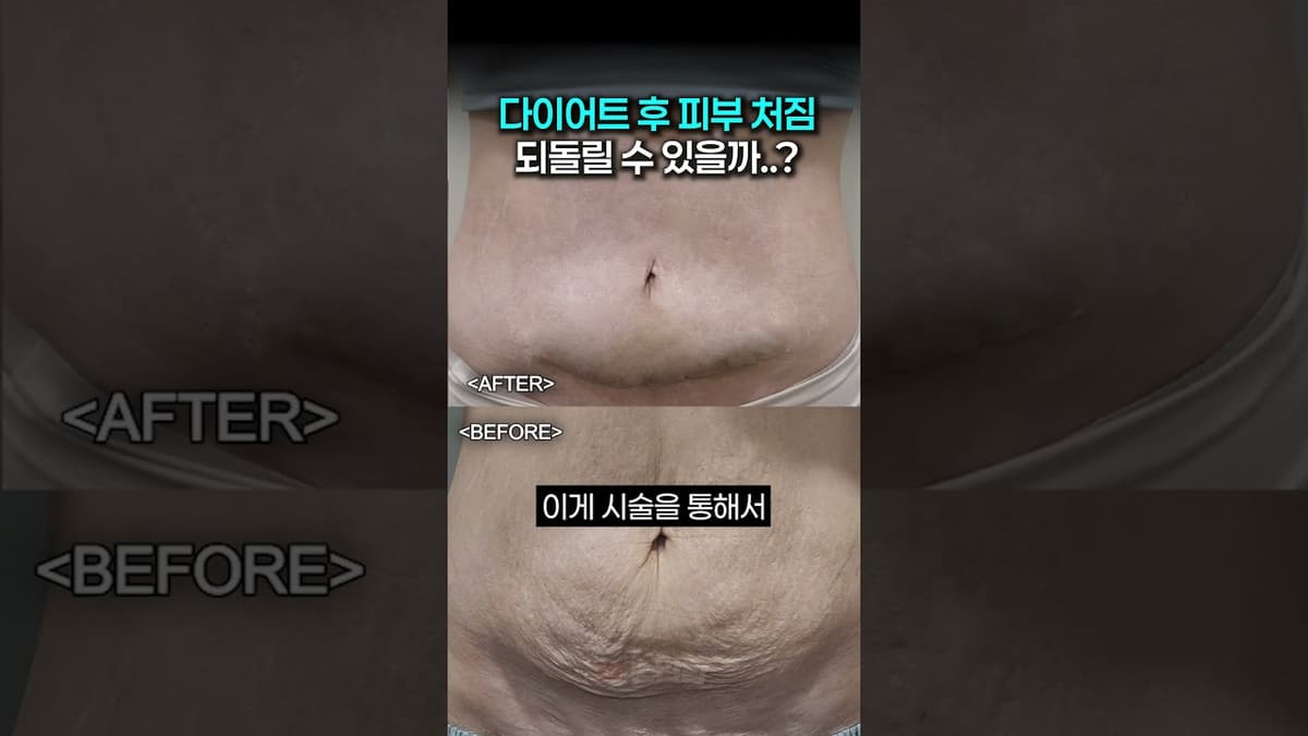 다이어트 후 튼살과 피부 처짐.. 되돌릴 수 있을까?