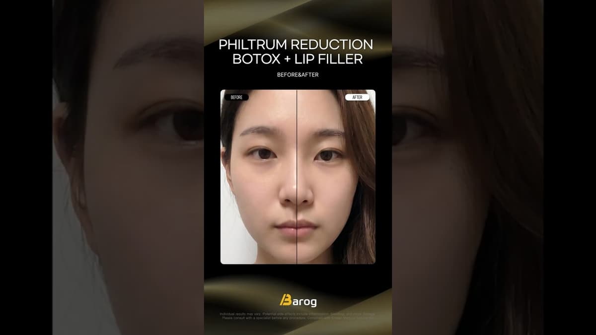 [Gangnam Clinic Seoul: 'Philtrum Reduction Botox + Lip Filler'  Before & After✨]