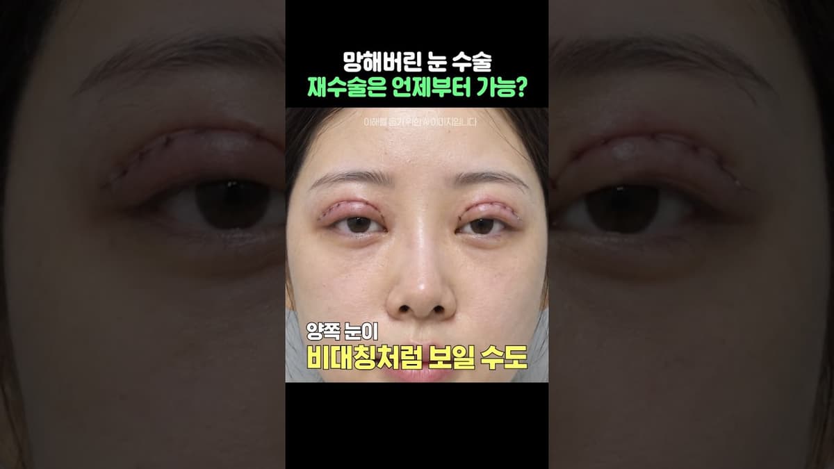 #雙眼皮修復手術時機，這樣做會出錯