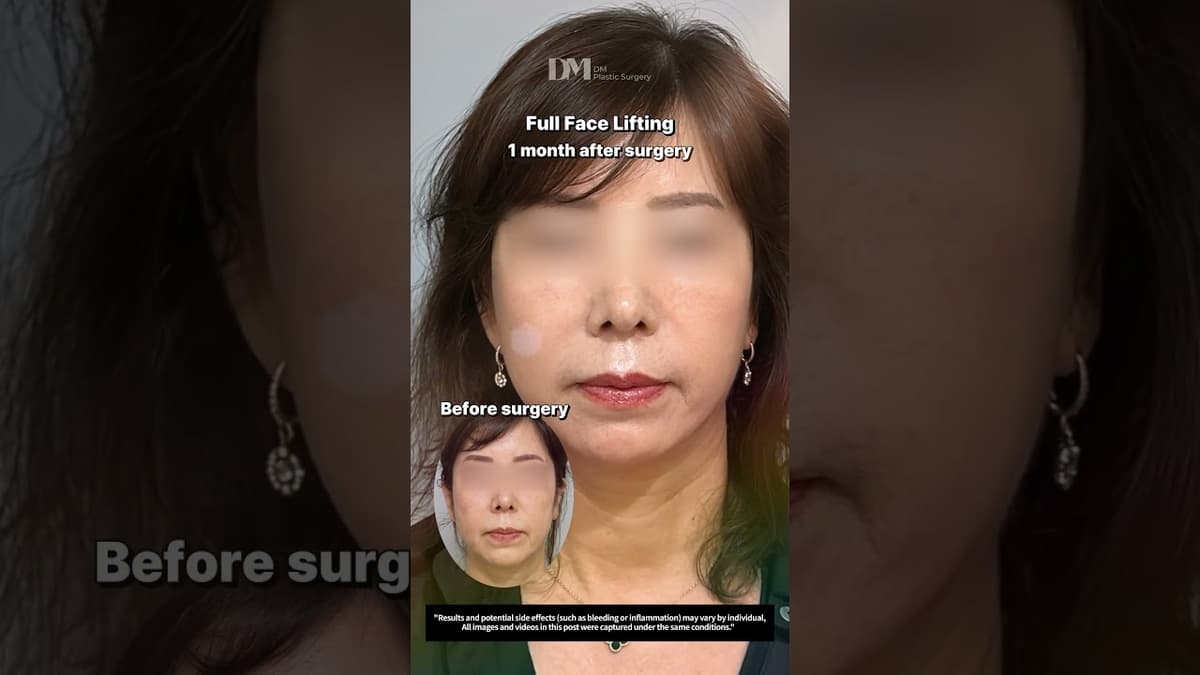 Sebulan selepas mengangkat muka sepenuhnya #trending #viral #facelift #necklift #deepplanefacelift #fyp