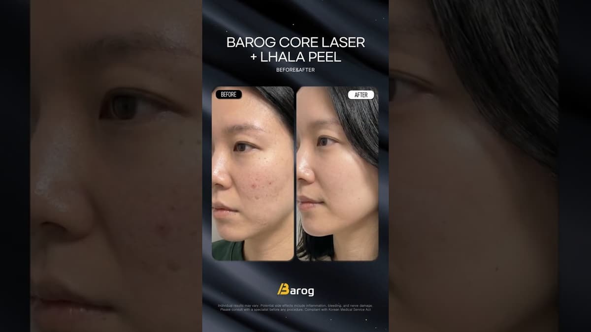 [Gangnam Clinic Seoul: 'LHALA Peel+Barog Core Laser' Before & After✨]