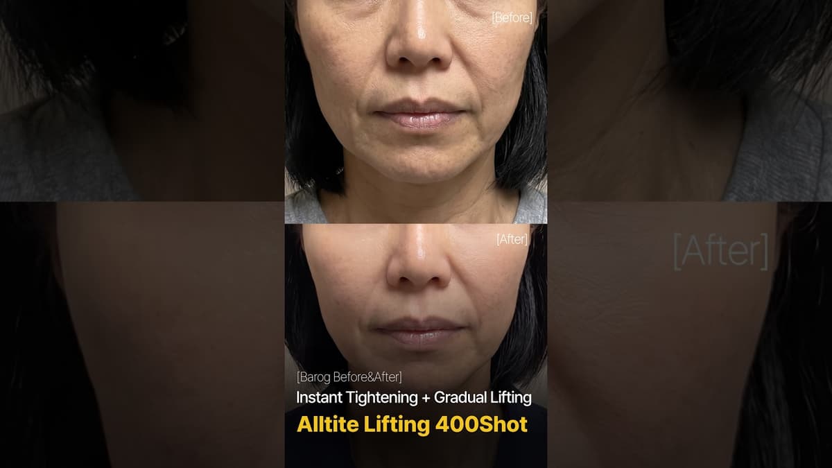 [Gangnam Clinic Seoul: Alltite Lifting 400 Before & After✨]