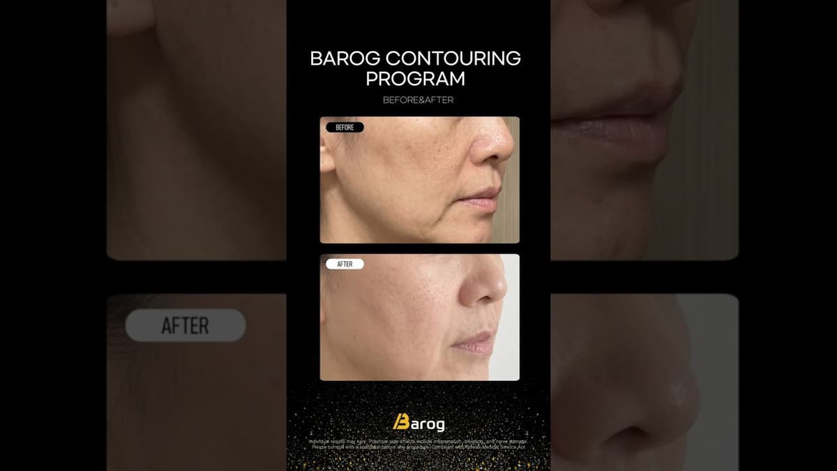 [Gangnam Clinic Seoul: 'Barog Contouring Program' Before & After✨]