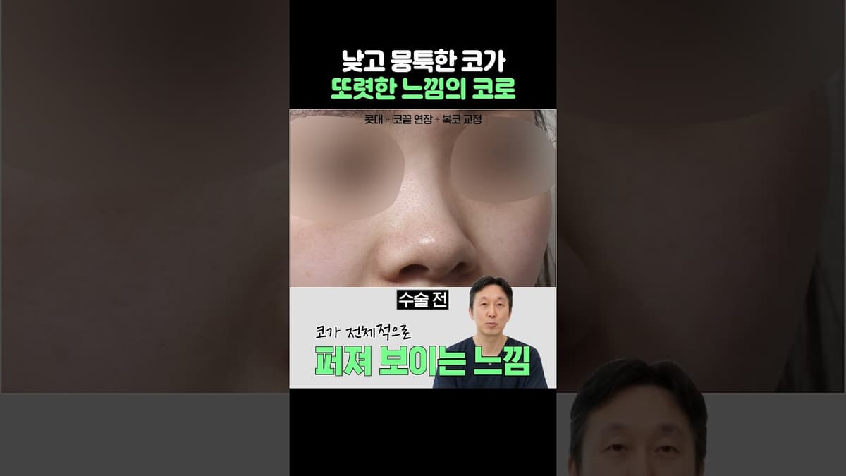 #복코 #복코수술 #코성형전후 #비포애프터
