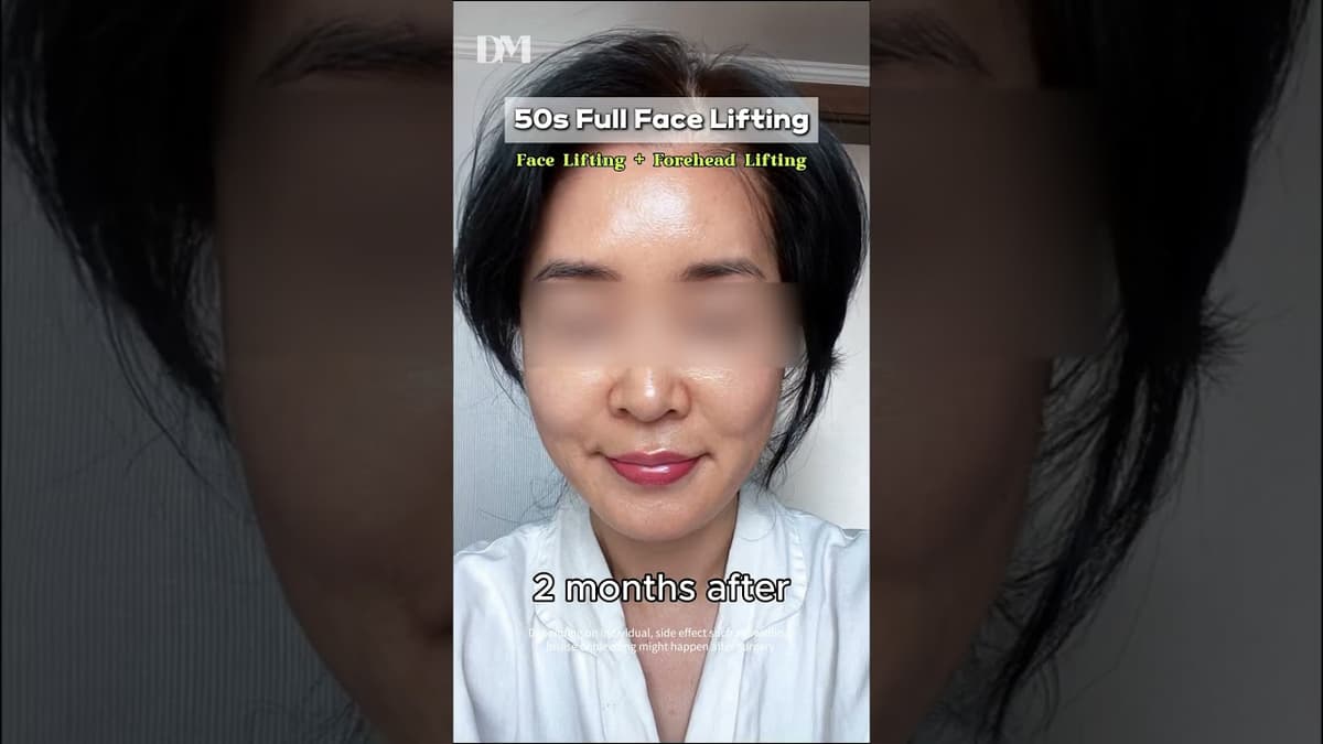 FULL FACE LIFTING IN YOUR 50s ✨ #facialrejuvenation #viral #facelift #smaslift #necklift #trend #fyp