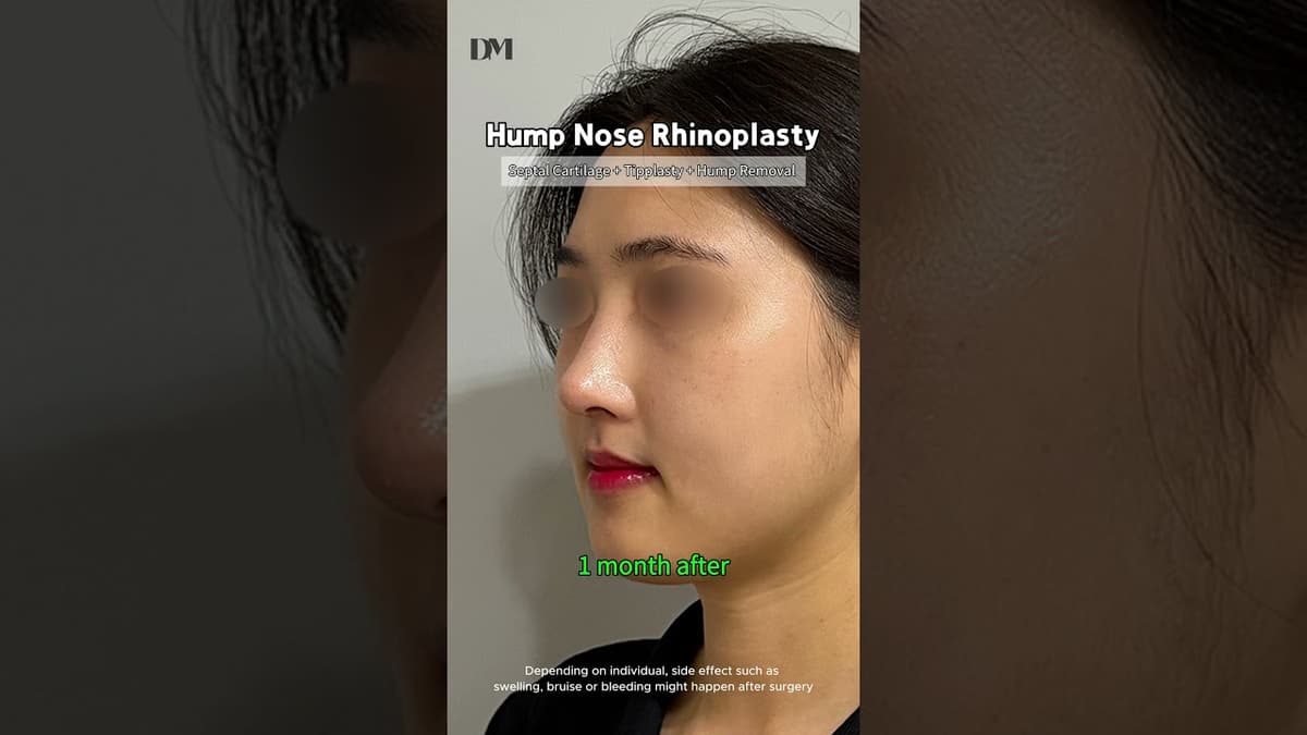Hump nose? Masculine image? Let's fix it #fyp #trend #viral #nosejob #rhinoplasty #beforeafter