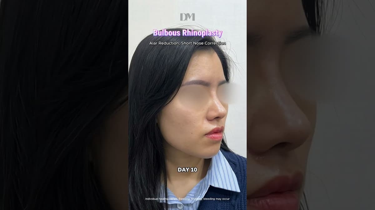 Bulbous nose transition #plasticsurgerykorea #rhinoplastykorea #nosesurgery #rhinoplasty #fyp #viral