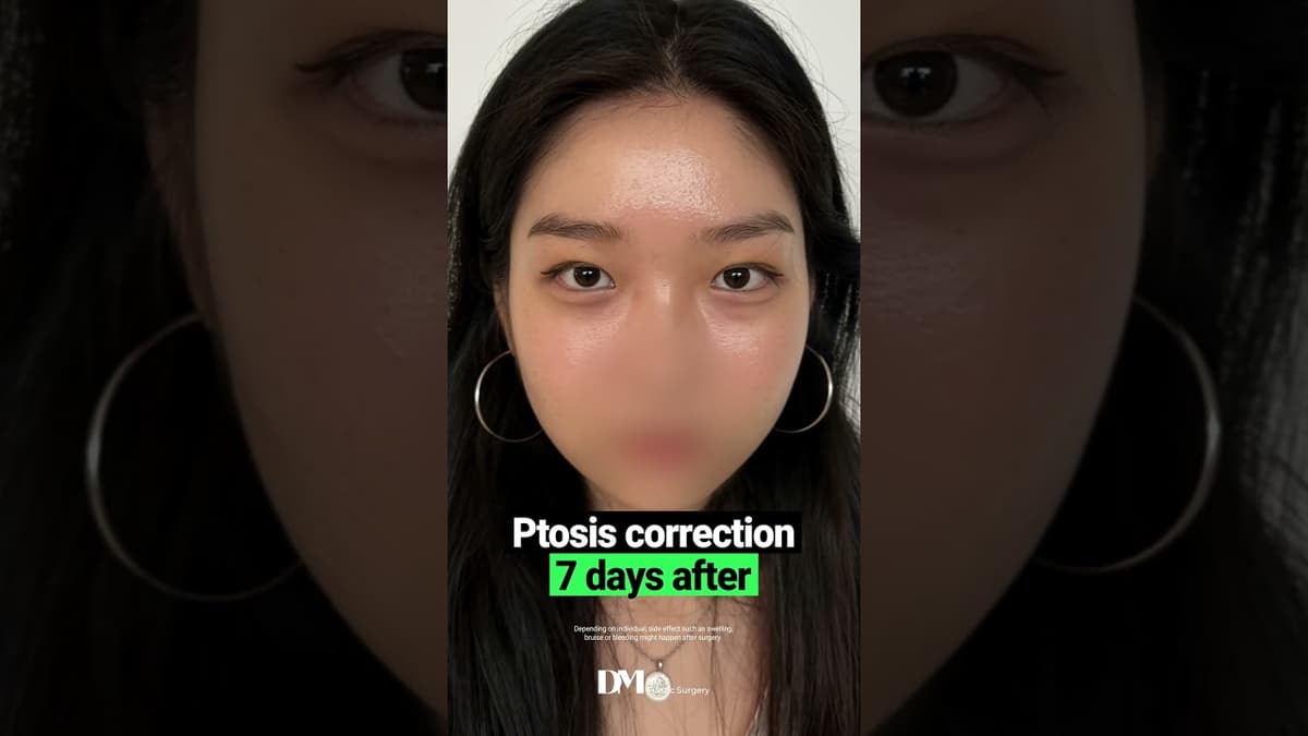 ดวงตาของคุณอาจดูเหนื่อยล้าได้แม้ว่าคุณจะไม่รู้สึกเหนื่อยล้าก็ตาม #viral #fyp #eyesurgery #ptosiscorrection #viralvideo