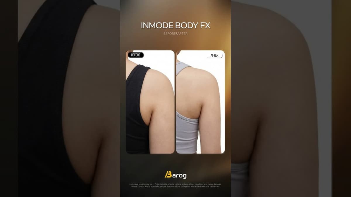 [Clinica Gangnam Seoul: InMode BodyFX Prima e Dopo✨]