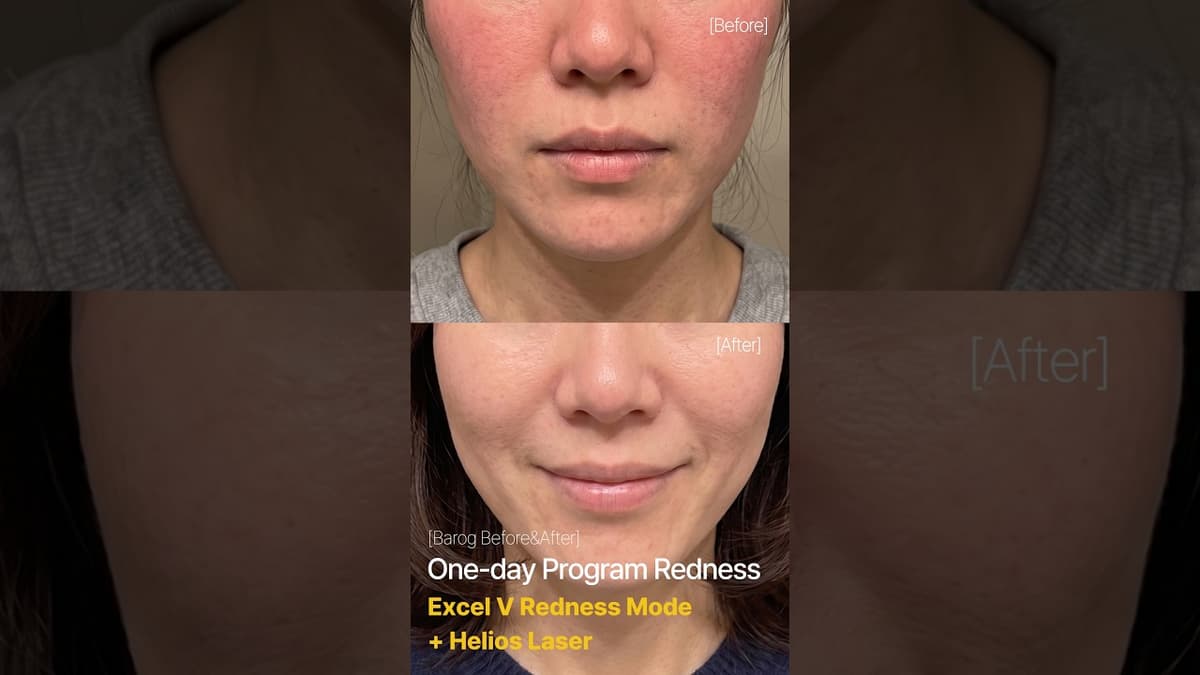 [Gangnam Clinic Seoul: 'One Day Program Redness' Before & After✨]