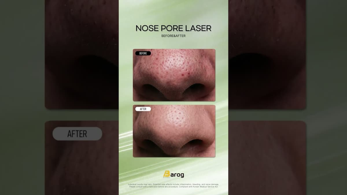[Gangnam Clinic Seoul: 'Nose Pore Laser' Before & After✨ ]