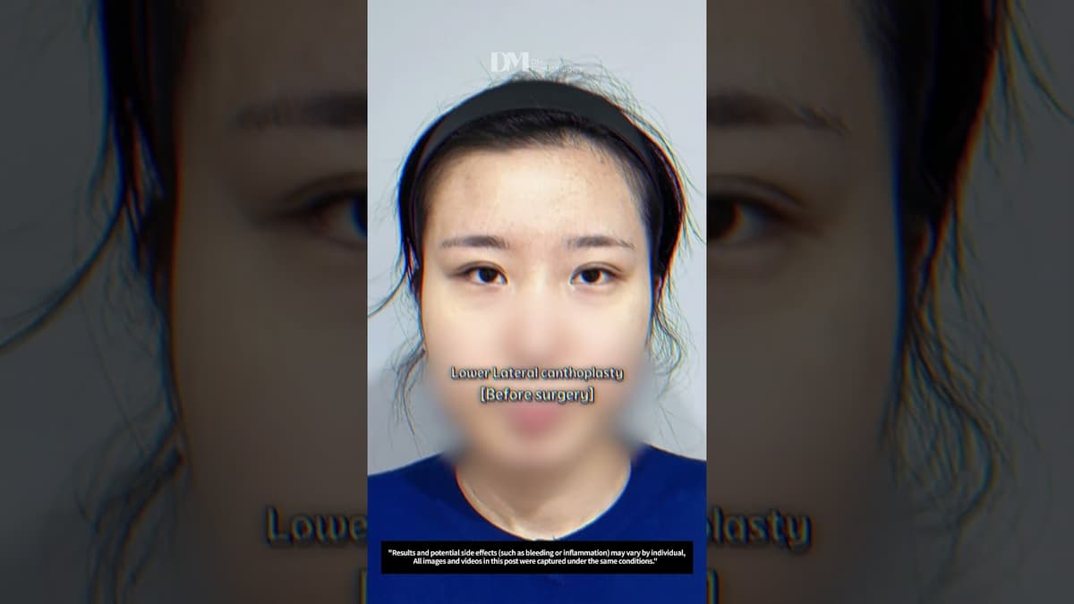 目を大きくする手術に興味がありますか？ #fyp #trending #viral #eyesurgery #eyeenlargement #seoulcafe