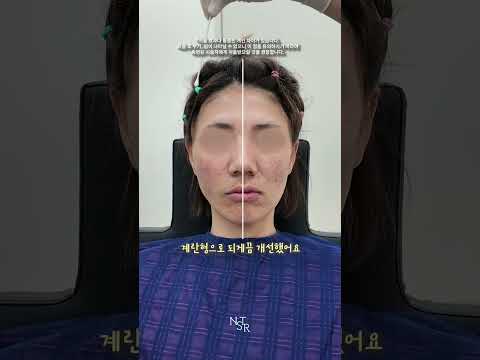 필러와 실리프팅으로 개선 케이스