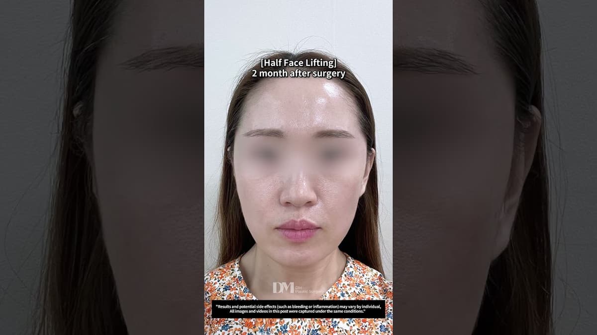 Who is a good candidate for a half facelift?  #viral #trend #facelift #halffacelift #midfacelift