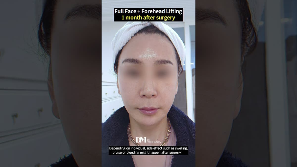 #Facelift , #Necklift , and #Foreheadlift triple surgeries, will I be super swollen? #viral #korea