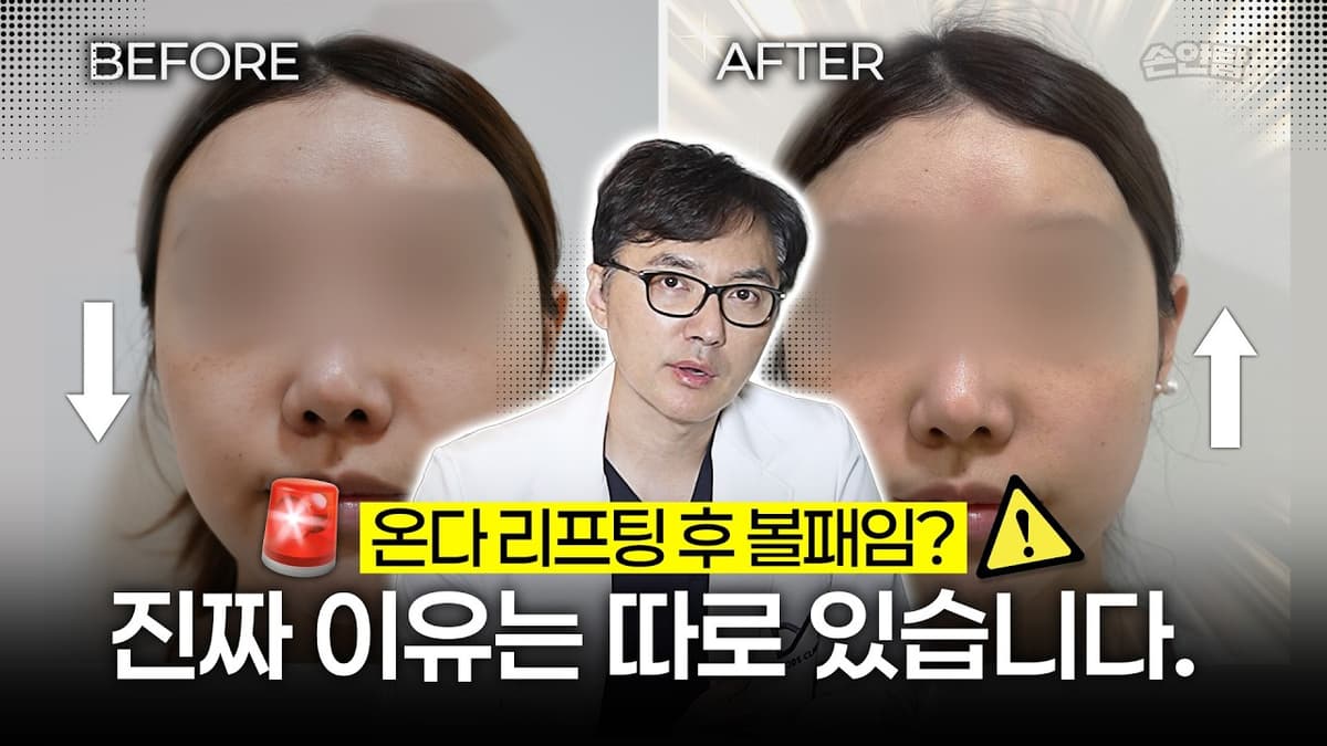 온다 리프팅 후에 볼패임..?⚠️ 진짜 원인은 따로 있다! 피부처짐, 팔자주름 고민이라면 필수 시청👀 시술 과정부터 시술 전후까지!