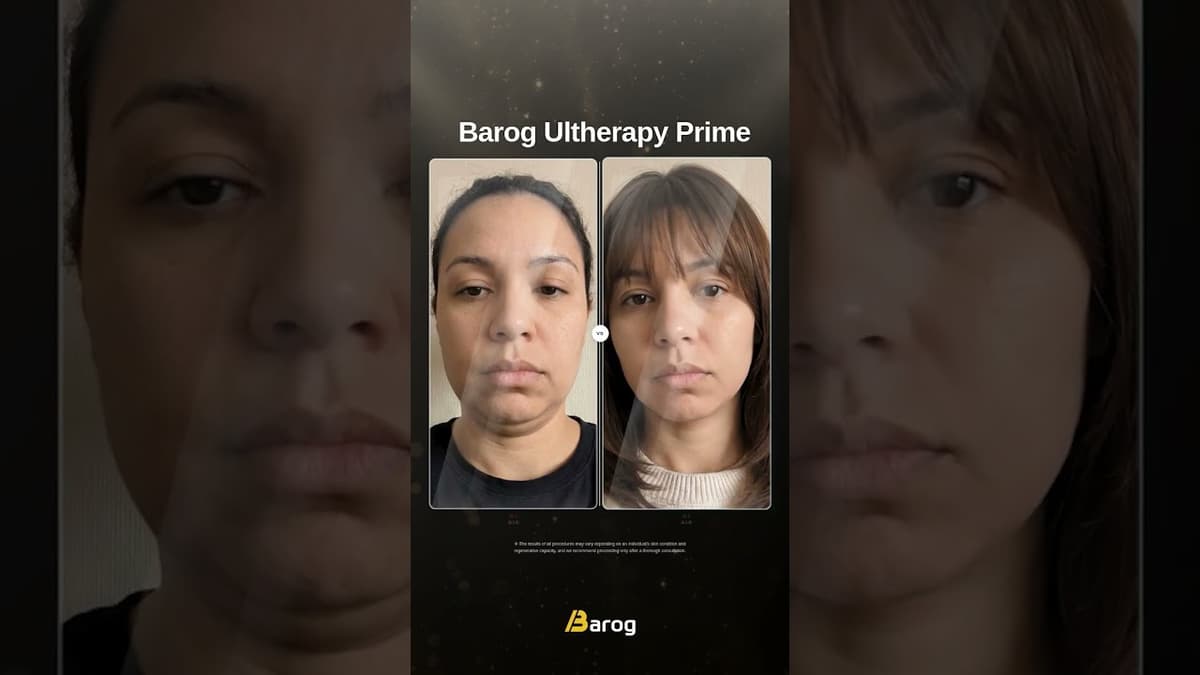 [Gangnam Clinic: Barog Ultherapy Prime Before & After✨]