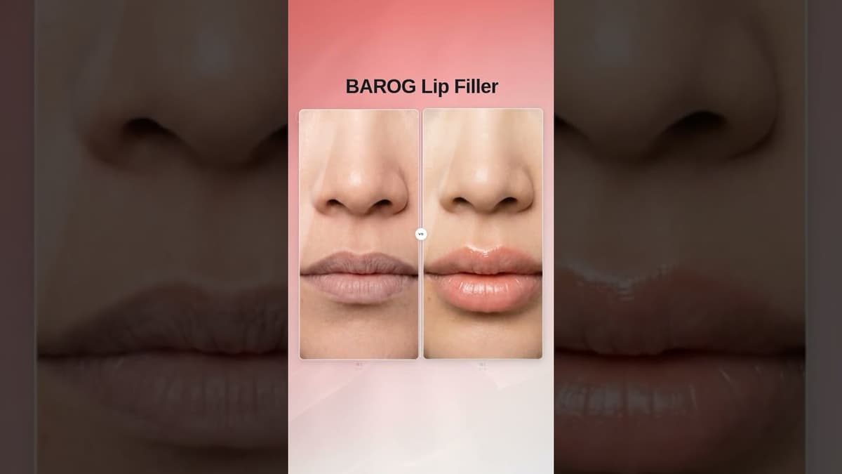 [Gangnam Clinic Seoul: Lip Filler Before & After✨]