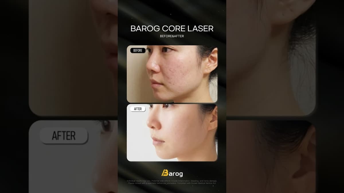 [Клиника Gangnam Seoul: Программа лазера «Barog Core» До и После✨]