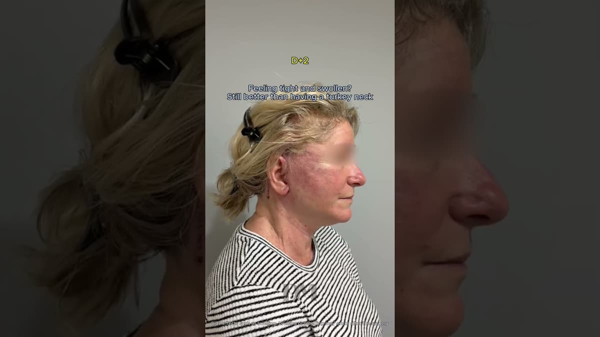 Face, neck lift recovery with DM #fyp #viralshorts #trend #facelift #recovery #aftercare #kbeauty