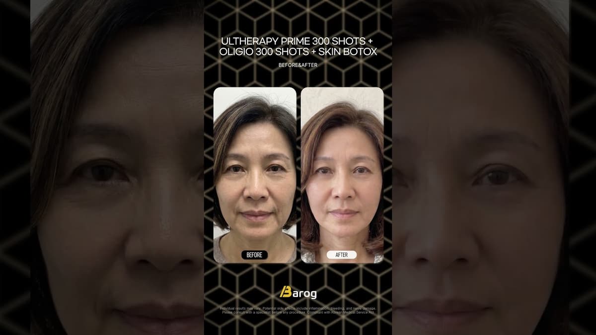 [Gangnam Clinic Seoul: Ultherapy Prime 300 Shots + Oligio 300 Shots + Skin Botox Before & After✨]