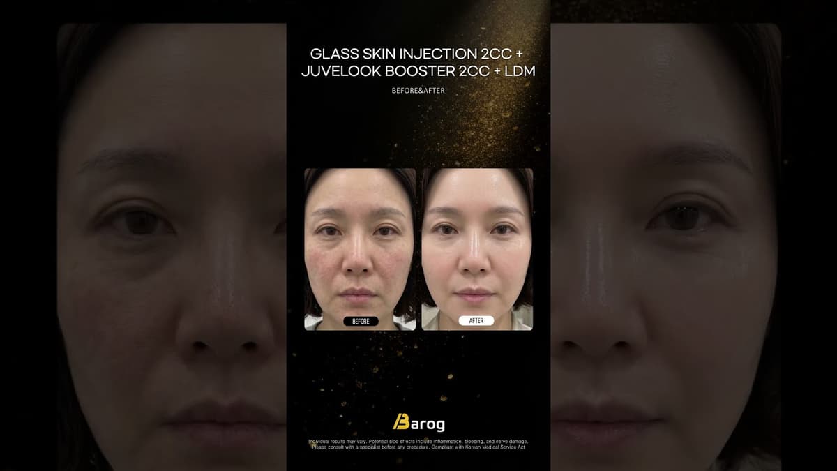 [Clinique Gangnam Séoul : Injection Peau de Verre (Aqua) 2cc + Juvelook Booster 2cc + LDM Avant/Après ✨]