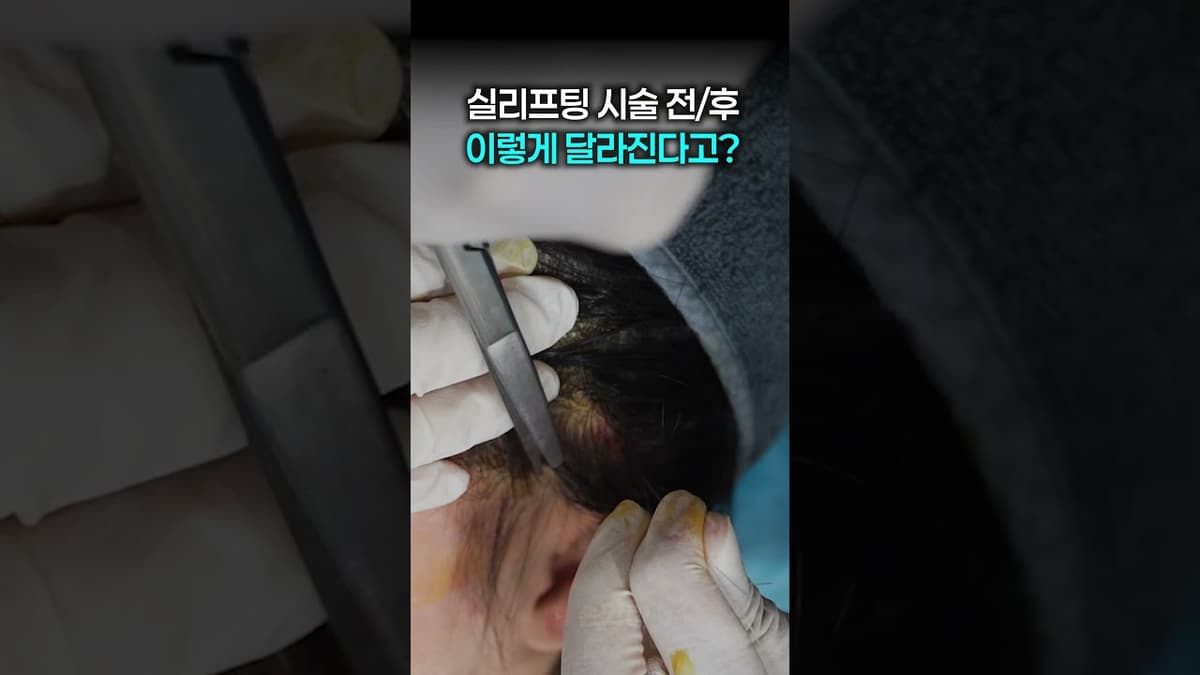실리프팅 시술 전/후 공개! 이렇게 달라진다고..?