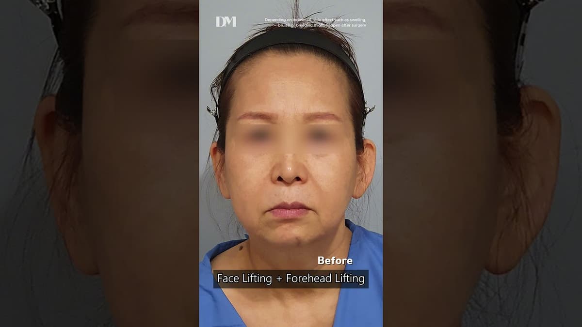 See those lines around the cheek, mouth, and jaw? #fyp #trending #viral #facelift #rejuvenation