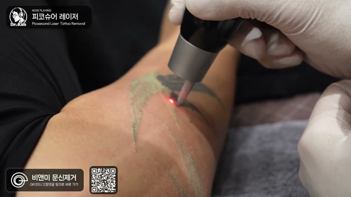 한 번에 문신 8개 지우는 상여자 👸🌺💥 Tattoo Removal ASMR
