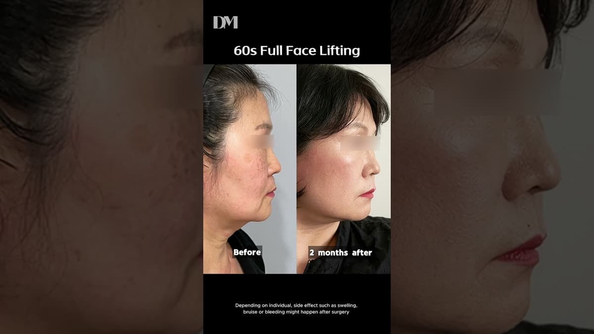 FULL FACE LIFTING IN YOUR 60s✨ #lifeinkorea #seoullife #trend #viral #plasticsurgerykorea #seoul