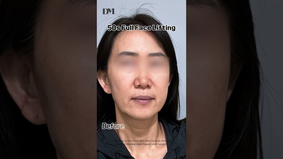 Risultato lifting anni '50 #lifting #fyp #tendenza #virale #risultatonaturale #chirurgiaplasticacorea #seoul #usa