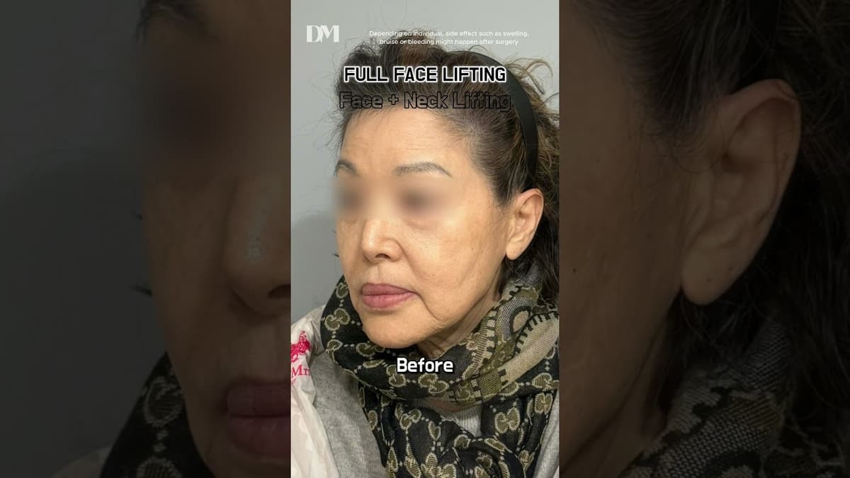 Face lift = time machine? That works? #viral #trend #viralvideo #fyp #beforeafter #facelift #natural