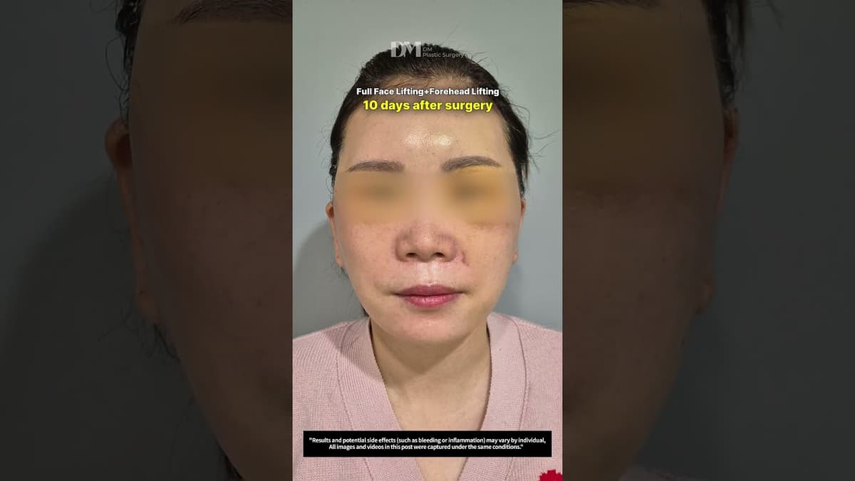 全脸及额头提拉，效果如何？#fyp #trending #viral #viralshorts #facelift #smas