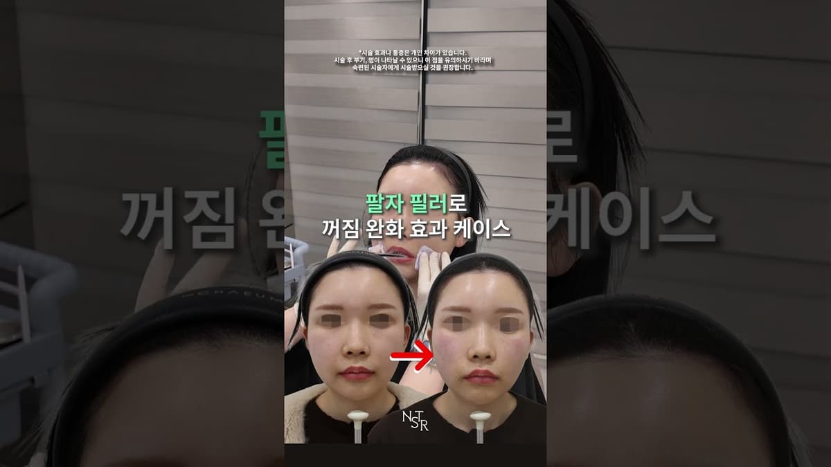 팔자 꺼짐을 필러로 개선 케이스
