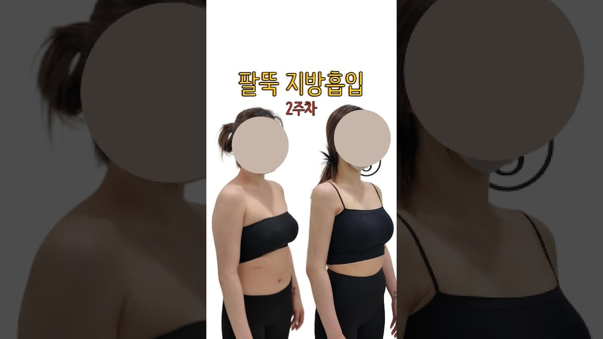 팔뚝 지방흡입, 많이 뺄수록 더 예뻐질까?｜팔뚝 지흡의 진짜 기준