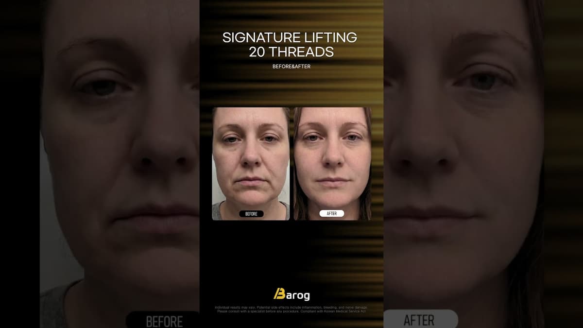 [Gangnam Clinic Seoul: 'Signature Lifting 20 threads' Before & After✨]