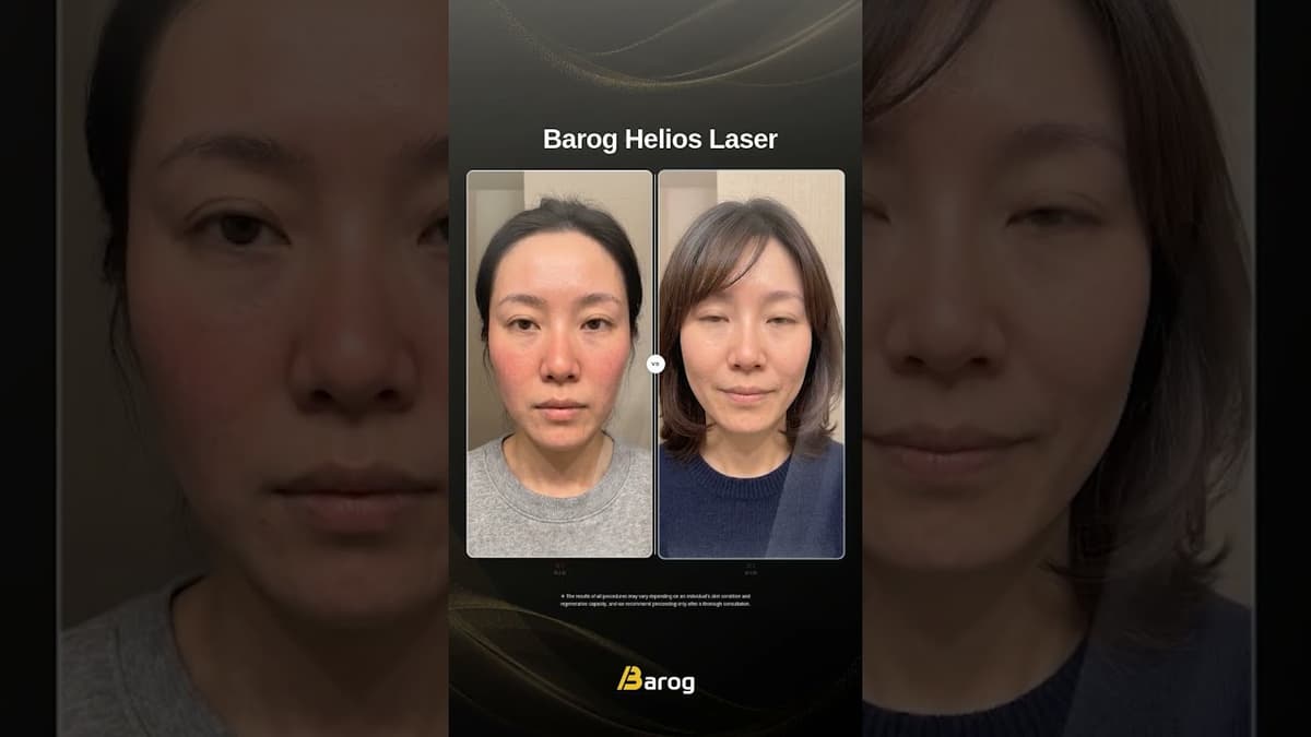 [Gangnam Clinic Seoul: Helios Laser Before & After✨]