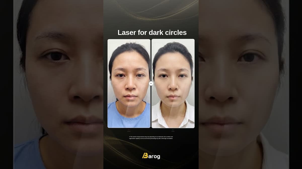 [江南診所：Barog 黑眼圈雷射術前術後✨]