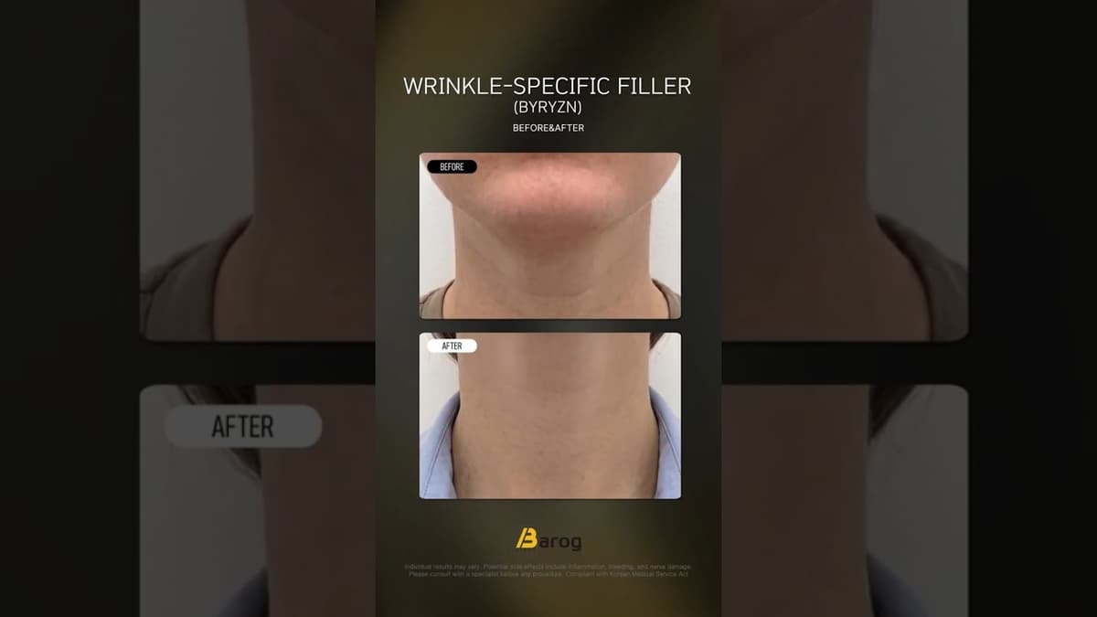 [Gangnam Clinic Seoul: 'Wrinkle-Specific Filler(ByRyzn)' Before & After✨]