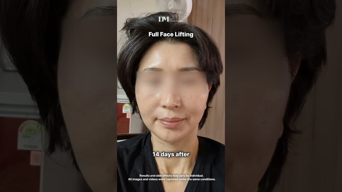 New #glowup #life starts with #facelift and #necklift #fyp #viral #trend #usa #viralvideo