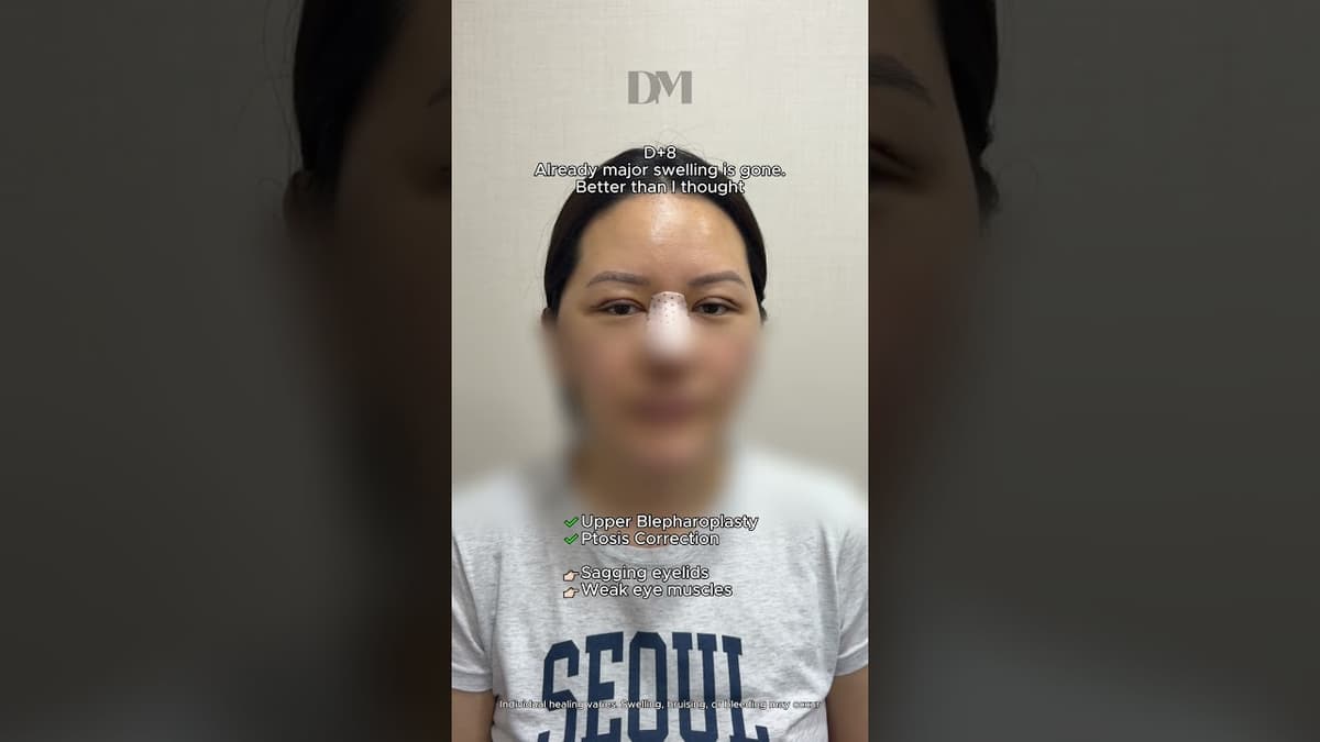 Từ mí mắt ẩn đến vẻ ngoài tươi tắn hơn #eyesurgerykorea #koreaeyesurgery #fyp #trending #viral #seoul