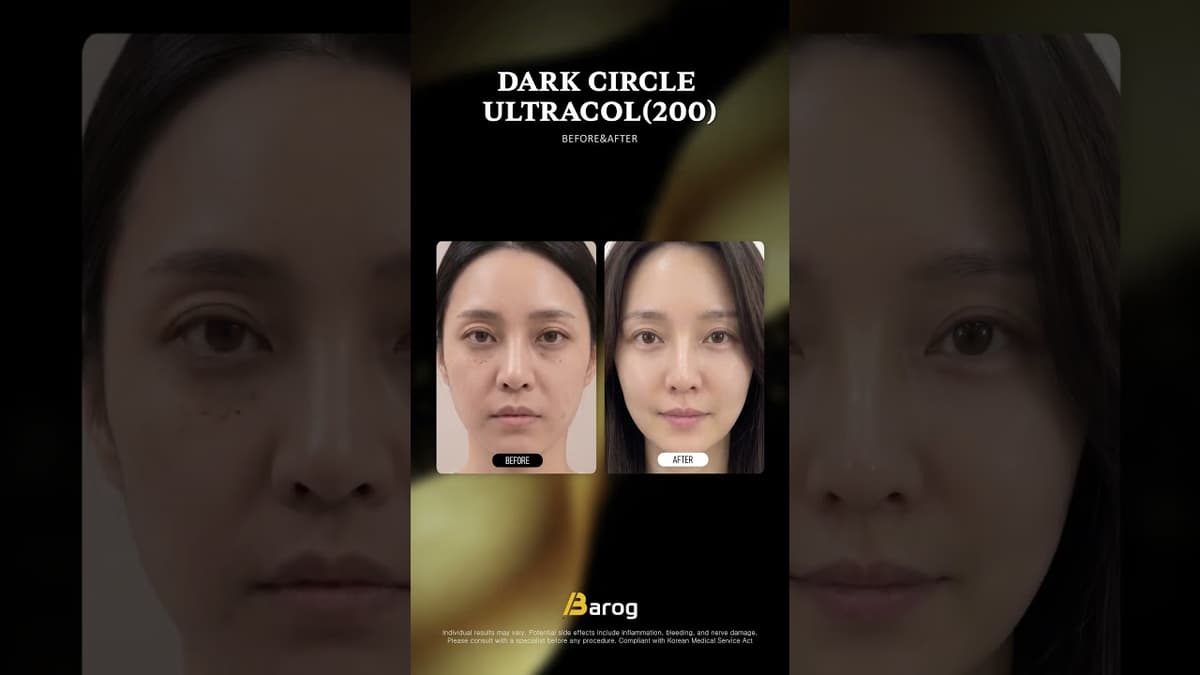 [Klinik Gangnam Seoul: Ultracol Lingkaran Gelap Bawah Mata Sebelum & Selepas✨]
