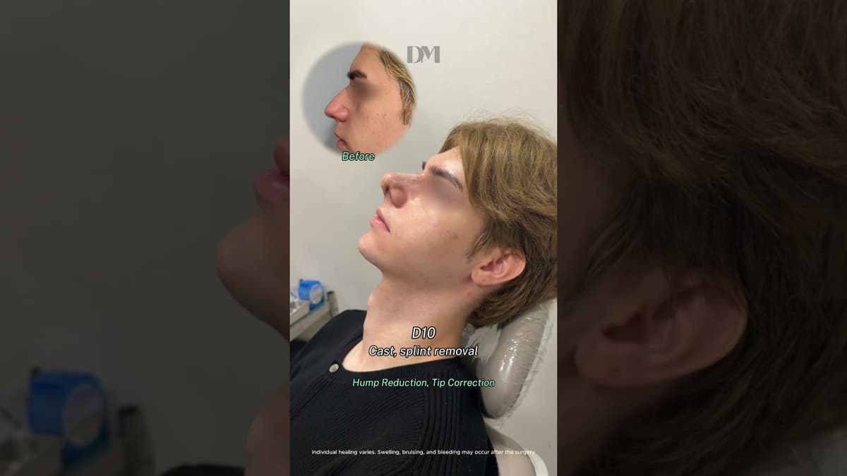 Severe hump reduction needed for him #rhinoplasty #nosejob #korea #plasticsurgerykorea #bts #fyp