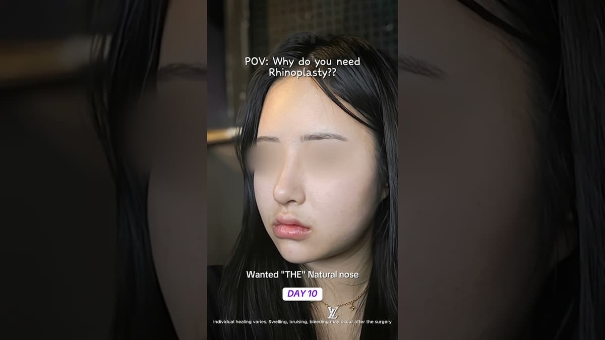 A natural, but more defined side profile🤍 #nosesurgery #rhinoplasty #korea #seoul #bts #fyp #viral