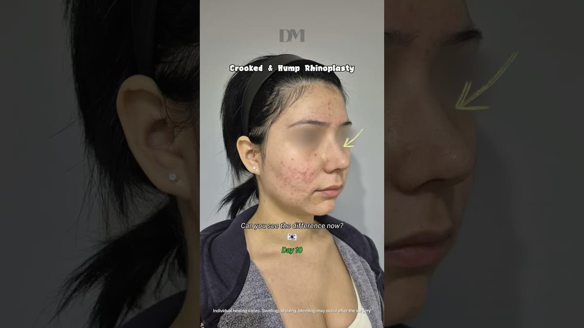 Masculine to Feminine Appearance #viral #nosesurgerykorea #rhinoplastykorea #beforeafter #kbeauty