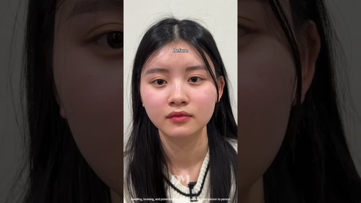 Natural, but more balance face🤍 #rhinoplasty #rhinoplastykorea #fyp #trend #viral #seoul #korea