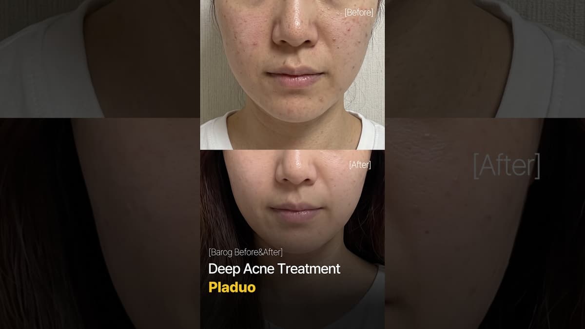 [Gangnam Clinic Seoul: 'PLADUO' Before & After✨]