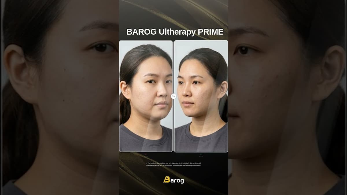 [Gangnam Clinic Seoul: Ulthera P-Prime Before & After✨] #kbeauty #barogclinic #skincare
